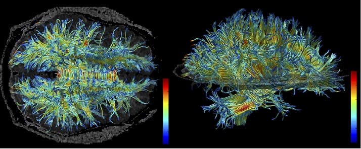White matter- MRI-brain injuries and depression-ColuccioLaw-Seattle