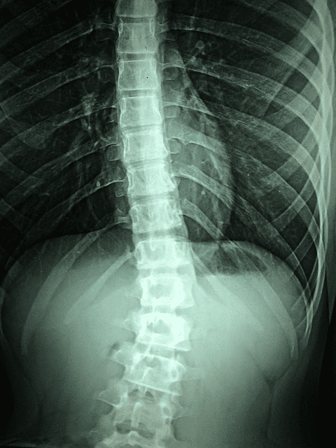 types of spinal cord injuries
