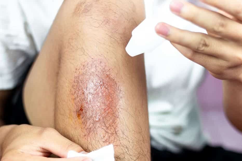 Burn Injury Legal Options